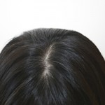 プラセンタの育毛効果で円形脱毛症が治る